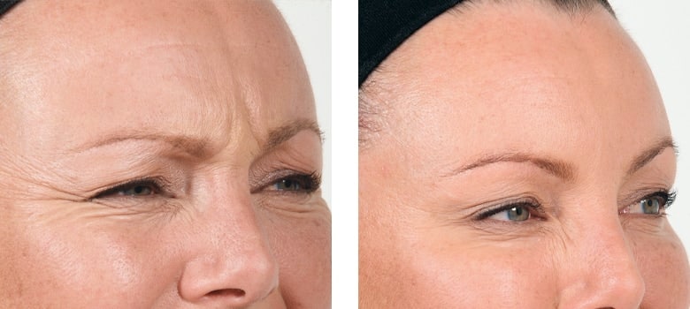 Anti wrinkle injections melbourne..